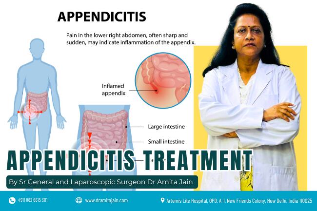Best appendicitis doctor surgeon in Delhi Dr Amita Jain